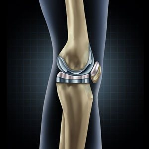 Joint Replacement image